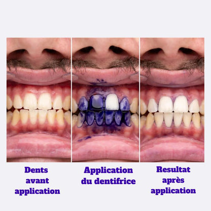 Dentifrice blanchissant︱SmileKit®